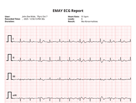 EKG