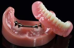 prothèse amovible sur implants Brossard-Laprairie, removable denture on implants Brossard-Laprairie