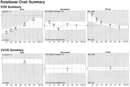 Rotary Chair Rotational Chair Test Vor Balancemd