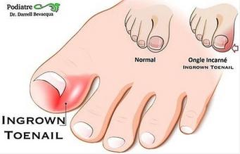 INGROWN TOENAILS, Foot Medical Centre