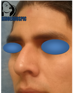 Rinoplastia antes