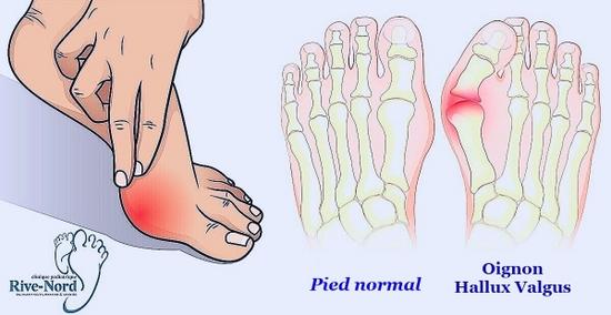 Chirurgie Hallux Valgus D lais d attente minimes