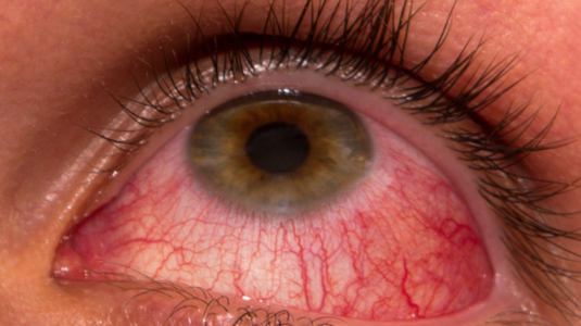 Conjunctivitis (Pink Eye)￼ - Dr. Joel Wallach