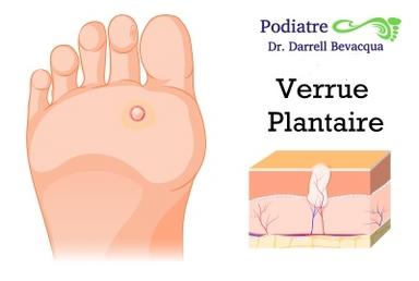 Verrue plantaire: cause, symptôme et traitement