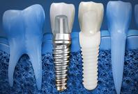 implant dentaire Brossard-Laprairie