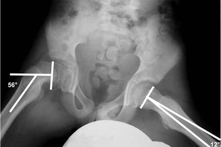 epiphysis of neck of femur