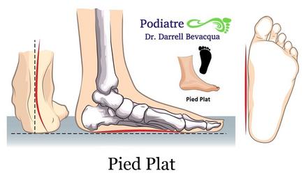 Le pied plat -  %