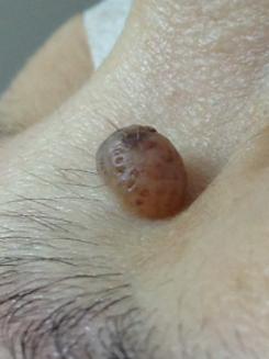 a protruding brown skin mole locates on the right side of the upper nose bridge