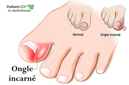 Ongle Incarne Correction Permanente Clinique Specialise