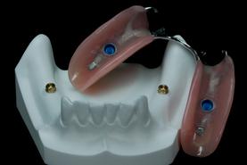 PROTHÈSE DENTAIRE PARTIELLE AMOVIBLE SUR IMPLANTS Michel Puertas Denturologiste Brossard-Laprairie, Fixed Denture On Implants Michel Puertas Denturologiste Brossard-Laprairie