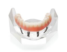 Fixed Denture On Implants Fix-On-4 Clinique Implantologie Dentaire