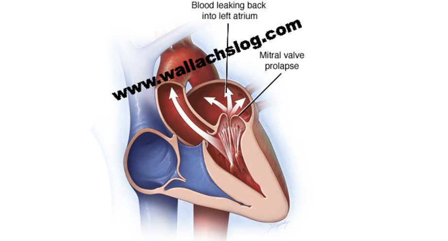 Mitral Valve Leak - Dr. Joel Wallach