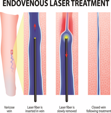 Varicose Veins Support Group: VariStop.com