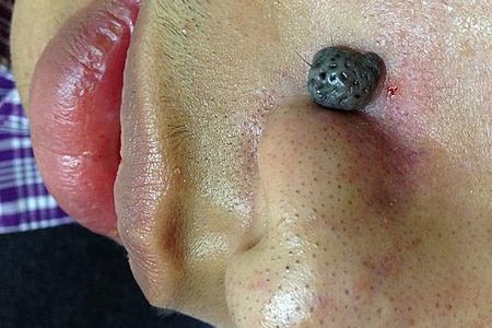 a huge black skin mole situates next to the nose