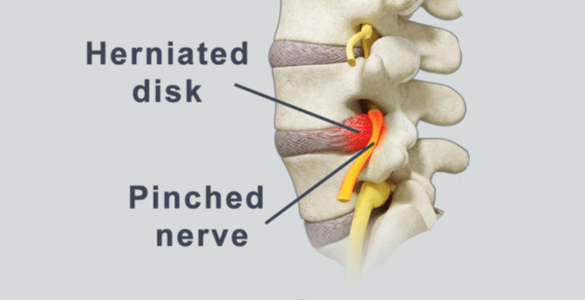 Pinched Sciatic Nerve - Dr. Joel Wallach