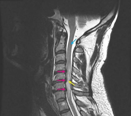 SPINAL CORD COMPRESSION – Causes and Risk Factors, Clinical Manifestations, Diagnostic Evaluations and Treatment