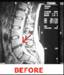 Newtown, PA - Spinal Decompression Therapy - Local Chiropractor & Dr. in Newtown, PA