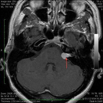 brain tumor mri without contrast