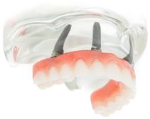 Prothèse Fixe Fix-On-4 Clinique Implantologie Dentaire