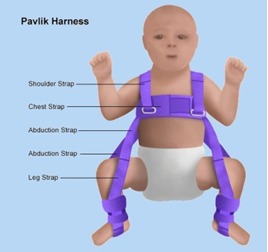 Signs of hip dysplasia hotsell in infants