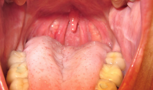 Chronic Sore Throat - Dr. Joel Wallach
