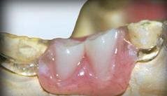 Partial Dentures Michel Puertas Denturologiste Brossard-Laprairie
