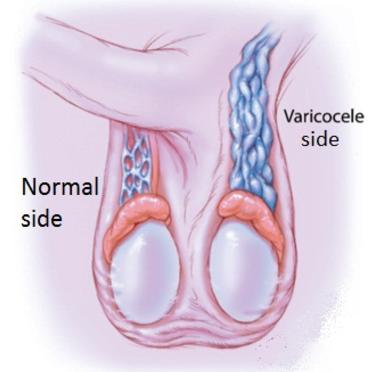 treatment for varicocele goa