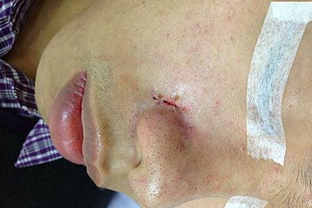 a picture showing that the wound was sutured up with 5/O dissolvable stitches