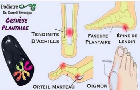 VERRUE PLANTAIRE - Clinique podiatrique Beauport