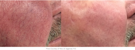 Cosmetic Injectables Center, Encino, Sherman Oaks Botox, Fillers, Restylane, Juvaderm, skin, redness, pigmentation, veins