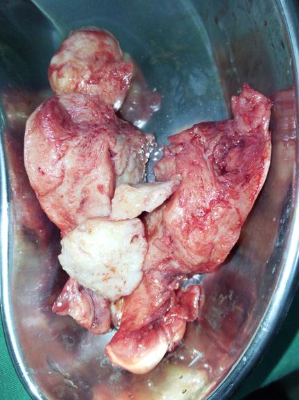 vaginal hysterectomy goa