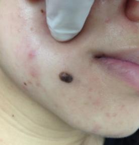 an elevated black nevus on the right lower face