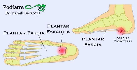 Permanent solution clearance for plantar fasciitis