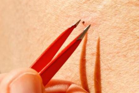 Tick removal with sharp tweezer