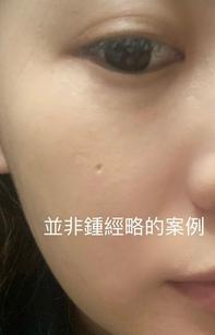 atrophic scar on face after mole removal