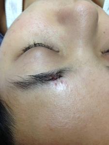 手術切墨後，拆線後的疤痕情況