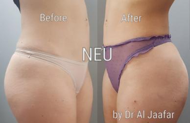 Brazilian butt lift (BBL) before and after photos