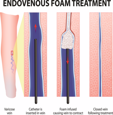 Varicose Vein Treatments, Guelph, ON