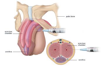 Penile injection therapy