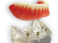 Denture On Implants Michel Puertas Denturologiste Brossard-Laprairie