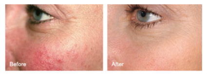 Cosmetic Injectables Center, Encino, Sherman Oaks Botox, Fillers, Restylane, Juvaderm, laser genesis, skin, pigmentation, redness, tightening, wrinkles