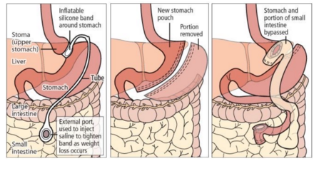 Bariatric Surgery Philippines Dr. Paolo Porciuncula