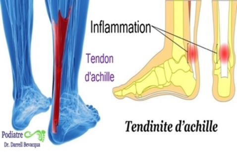 Tendon d achille Tendinite d achille douleur solutions