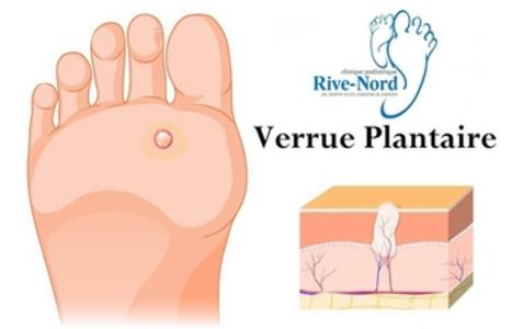 Verrue plantaire – NARAVIE – Be Healthy in a Click!