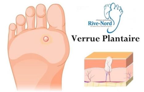 Verrue plantaire - Pied Outaouis