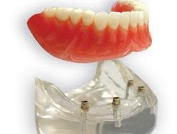 Prothèse Dentaire Sur Implants Michel Puertas Denturologiste Brossard-Laprairie, Denture On Implants Michel Puertas Denturologiste Brossard-Laprairie