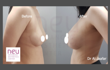 Breast implants before and after photos