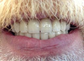 Patients Clinique Implantologie Dentaire Dental Implants Brossard-Laprairie