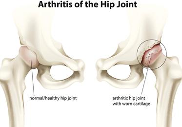 Femoroacetabular Impingement