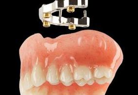 Denture On Implants With Bar Michel Puertas Denturologiste Brossard-Laprairie